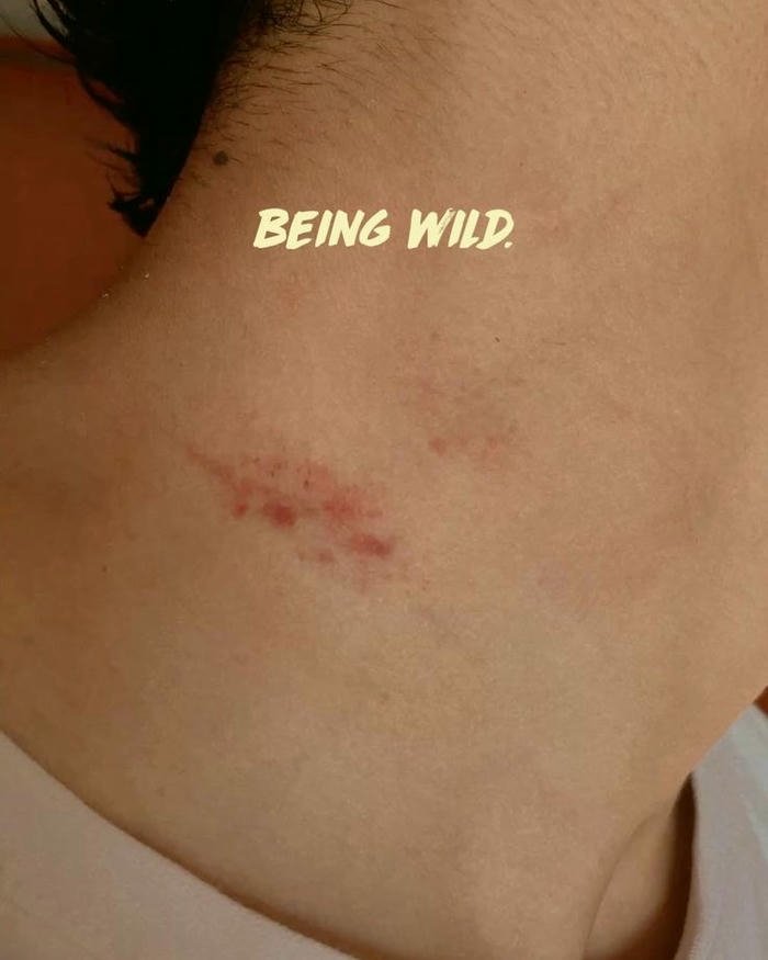 Collarbone red scratch mark skin close up view