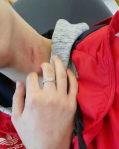 Hand holding neck red hickey mark close up