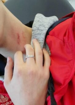 203+ Cute Love Bites Images Showing Passionate Moments - Featured post in Love