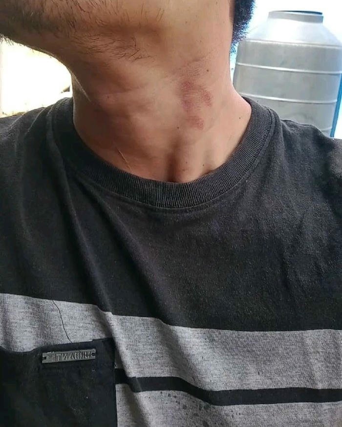 Love bites images grey shirt neck red mark view