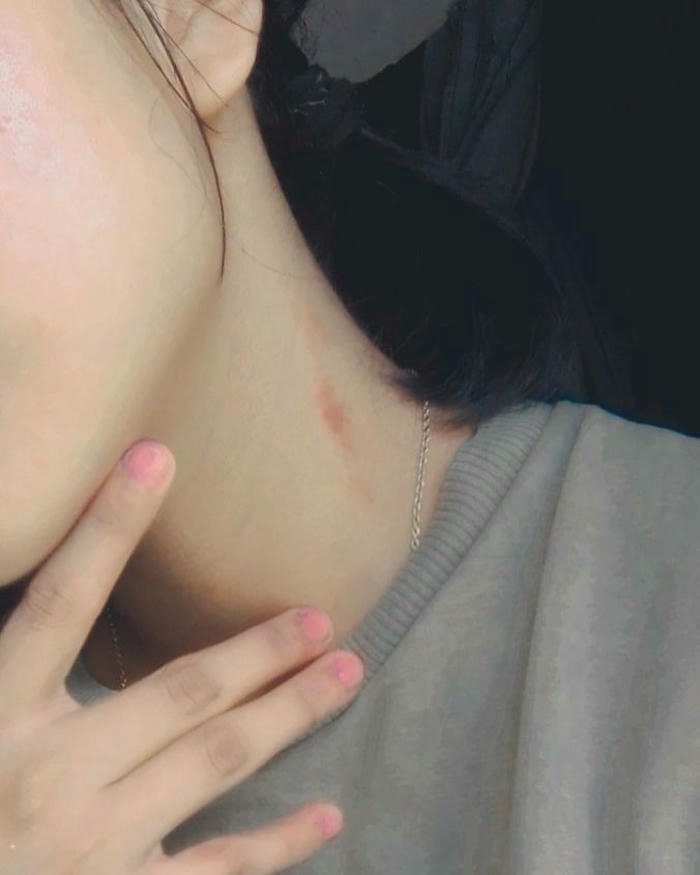 Love bites images hand touching neck red mark skin