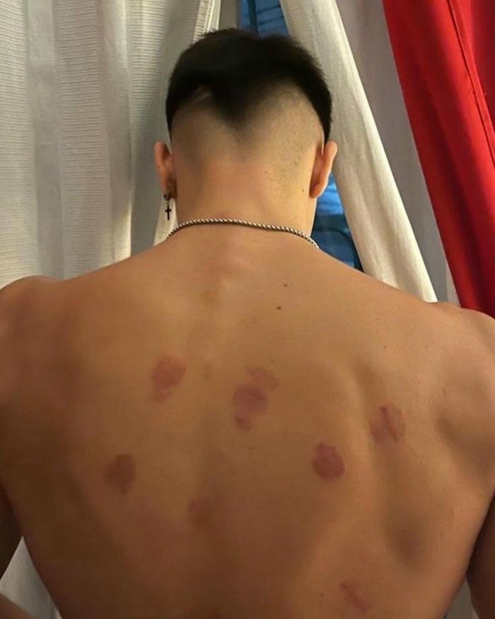 Love bites images man back scratches red marks view