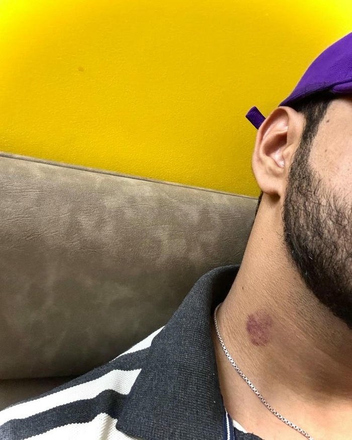 Love bites images man beard neck dark hickey view