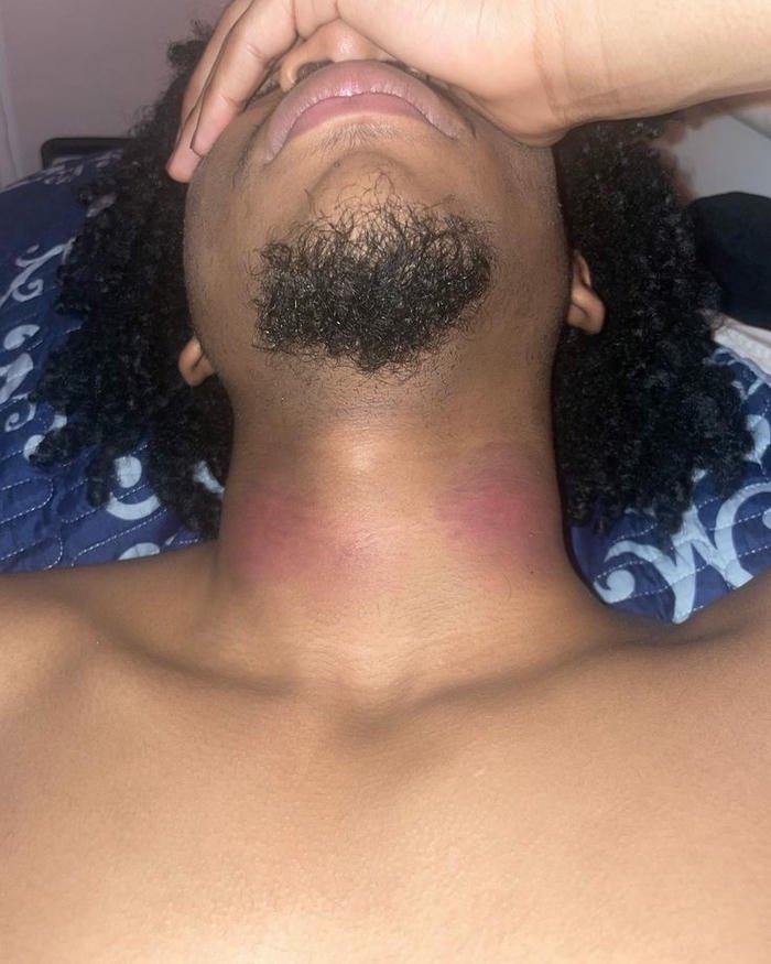 Love bites images man looking up purple neck mark