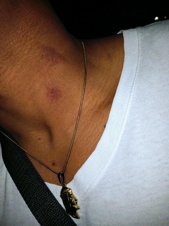 Love bites images man necklace neck large red mark