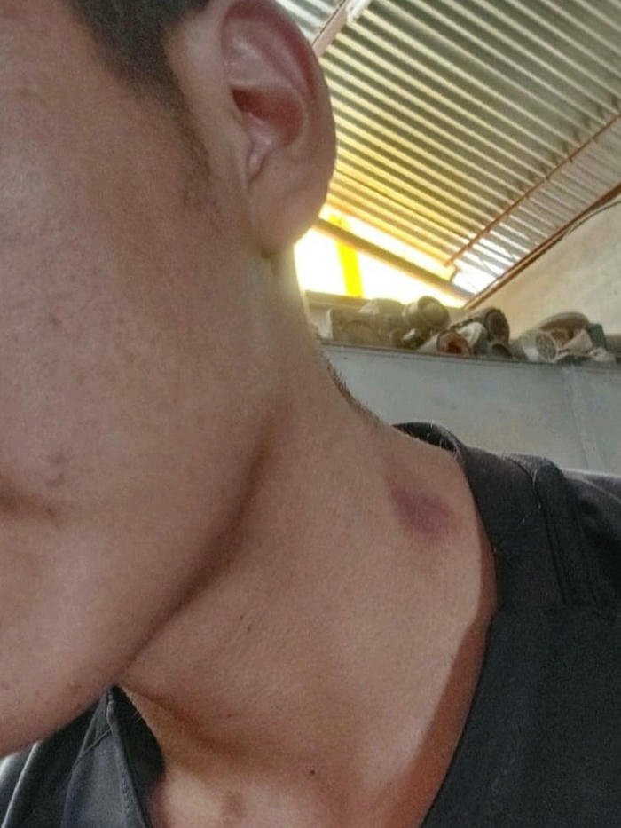 Love bites images man profile neck dark bite mark