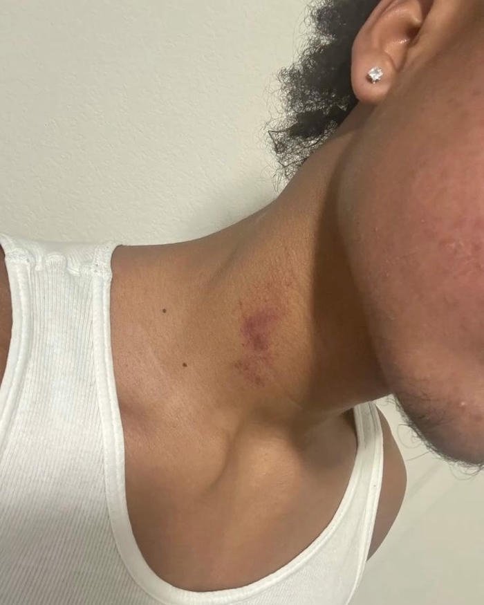 Love bites images man white vest neck red mark