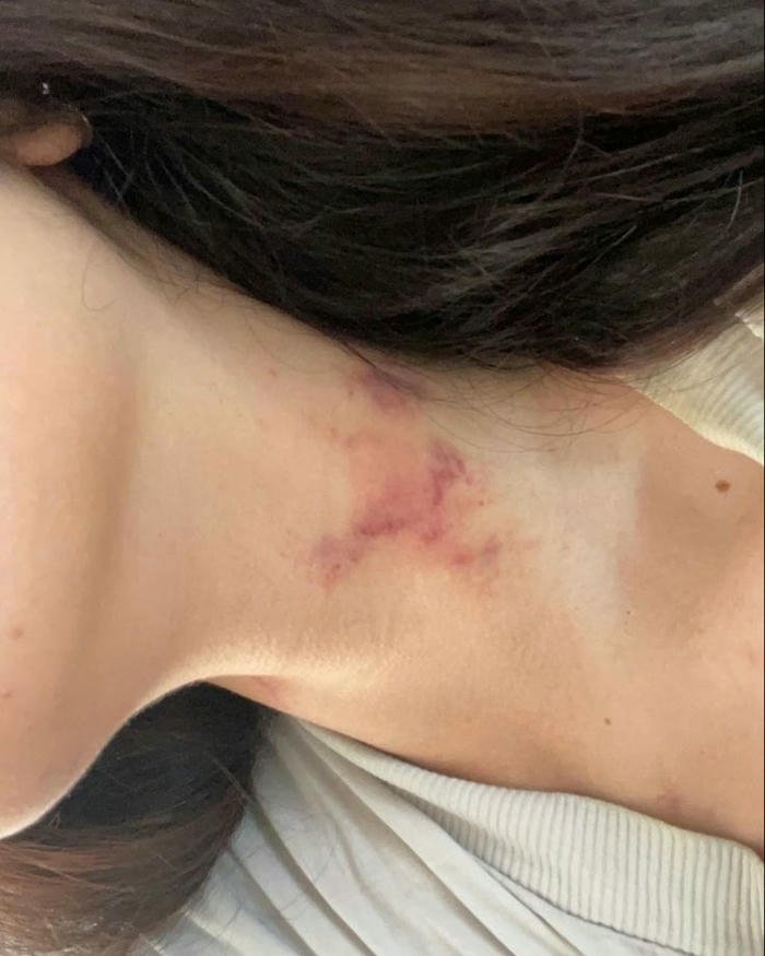 Love bites images woman long hair neck red mark