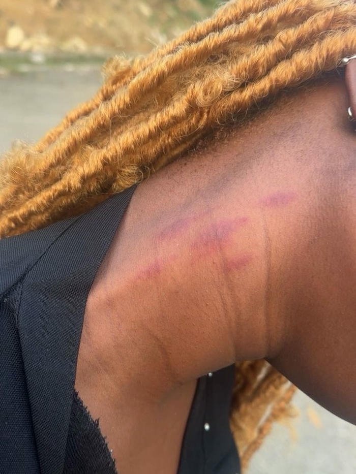 Love bites images woman neck red bruise mark close