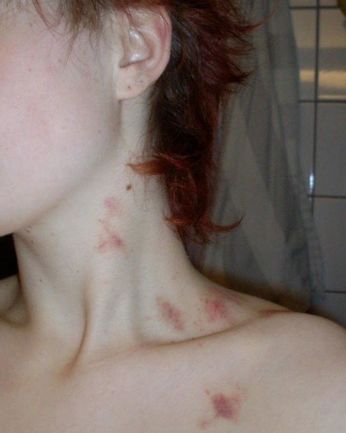 Love bites images woman pale neck multiple red marks