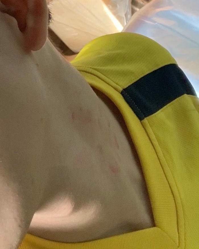 Love bites images yellow shirt neck red mark side