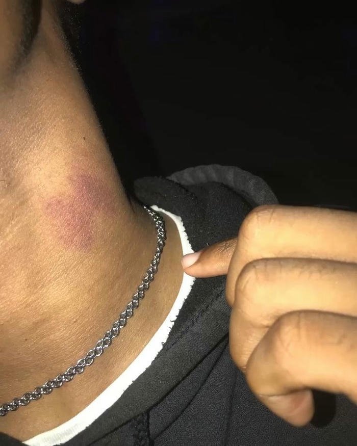 Man chain necklace neck red hickey mark view