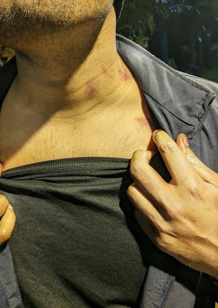Man pulling shirt revealing neck red marks view