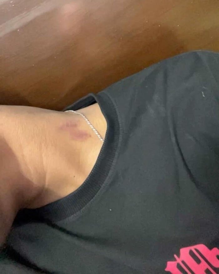 Man wearing black shirt neck red hickey mark