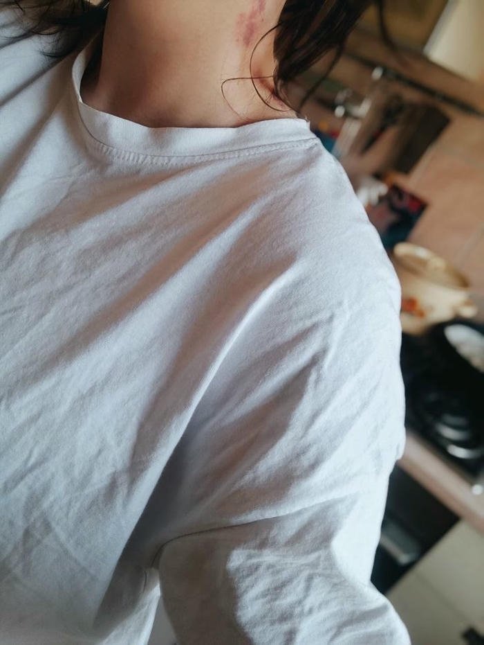 Man white t-shirt neck red hickey mark view