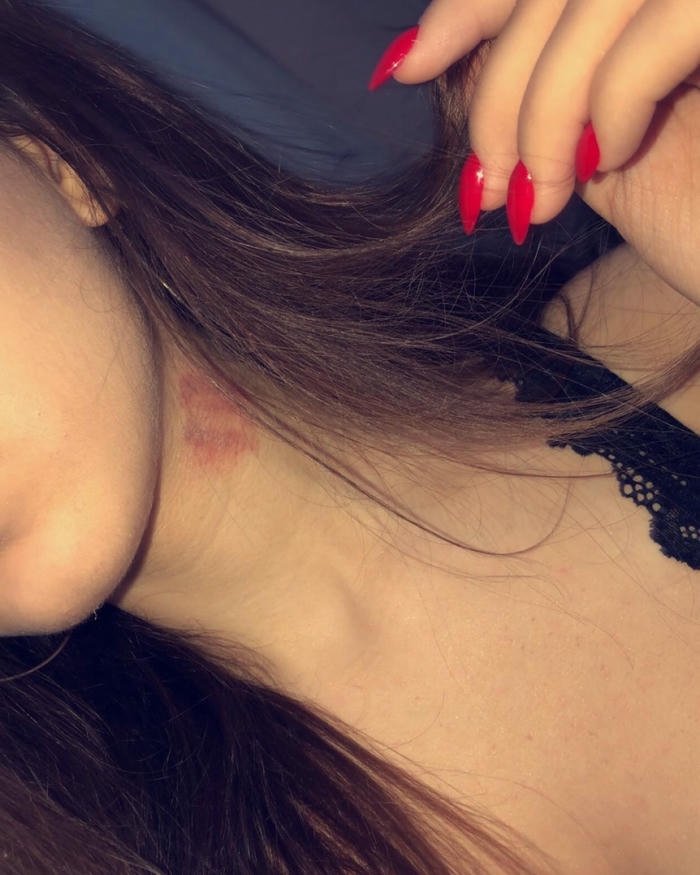 Woman dark hair neck red hickey mark view