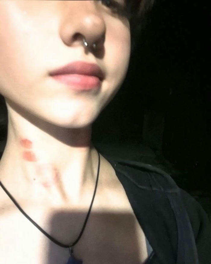 Woman pale skin neck red hickey close up